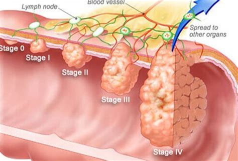 The vast majority of colorectal cancers arise from polyps. Colon Cancer Symptoms, Survival Rate, Treatment & Stages