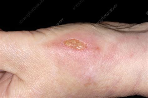 Infected Burn Stock Image C0024955 Science Photo Library