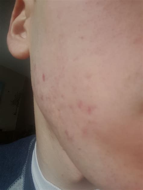 Acne Scars After Accutane W Images Hyperpigmentation Reddark