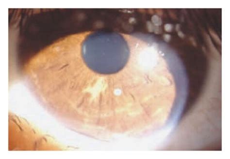 Slit Lamp Photograph Of The Anterior Segment In A Patient With Tuberous