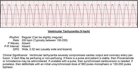 Ventricular Tachycardia V Tach Ecg Acls Wiki