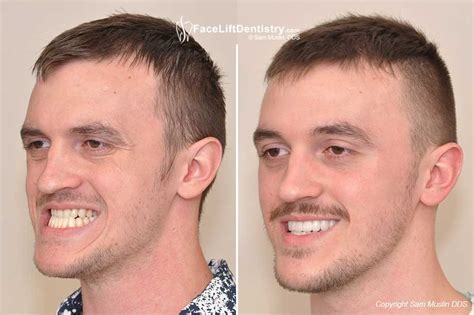 Underbite affects quite a few people but luckily it can be treated. Underbite Correction - No Drilling, No Surgery, In 3 Weeks