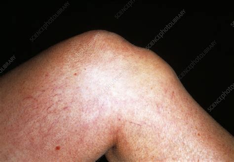 Bursitis Of Knee Stock Image M1200107 Science Photo Library