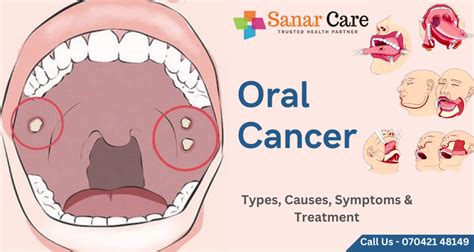 Oral Cancer Types Causes Symptoms Treatment