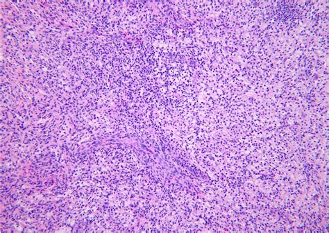 Pathology Outlines Tenosynovial Giant Cell Tumor