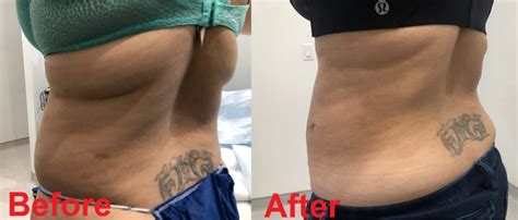 Liposuction Fort Lee Before After Lipo Photos Weehawken Nj
