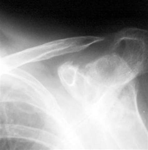 Osteolysis Of The Distal Clavicle Pacs