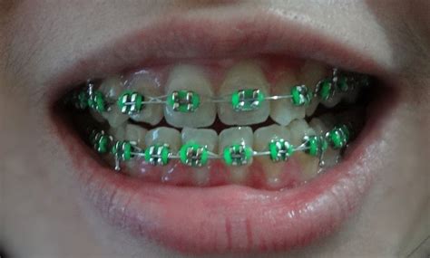 Viewing Gallery For Neon Braces Colors Braces Colors Green Braces Teeth Braces