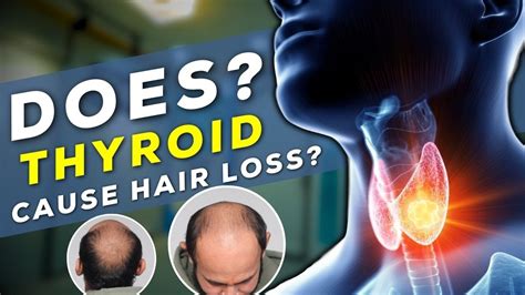 Thyroid Hair Loss Does Thyroid Causes Hair Loss Youtube