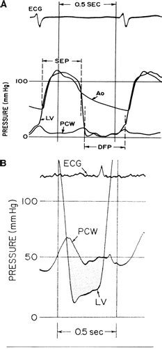 Modern Management of Mitral Stenosis | Circulation