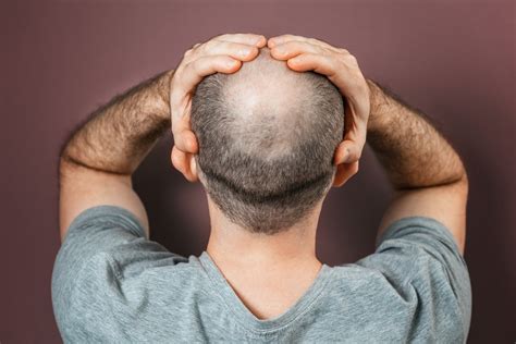 Aggregate 80 Bald Spot In Hair Super Hot Ineteachers