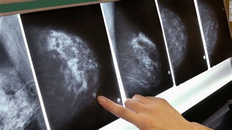 Estudio Una Mamografía Con Resultado Falso Positivo Es Real Factor De