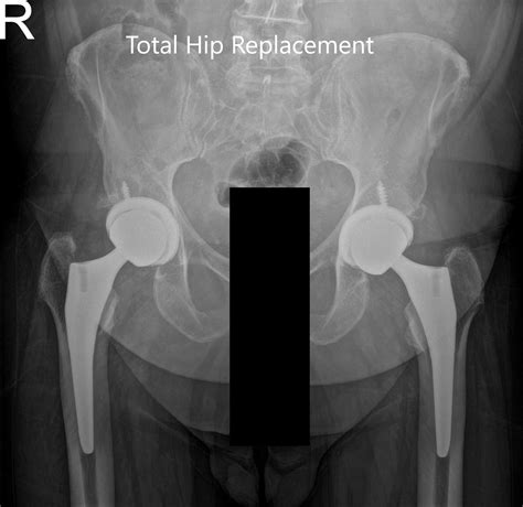 Top 102 Pictures Posterior Hip Replacement Scar Pictures Excellent