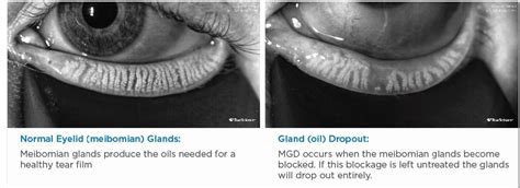 Eyelid Glands