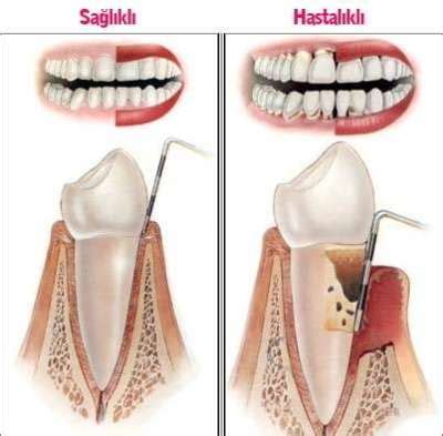 Diş Çürüğü ve Diş Eti Hastalıkları Sertaç Kızılkaya İstanbul