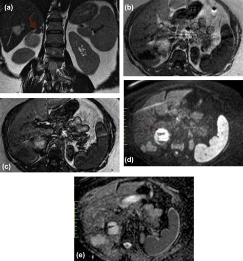 A 48 Year Old Woman With Right Adrenal Collision Tumor Composed Of A Download Scientific