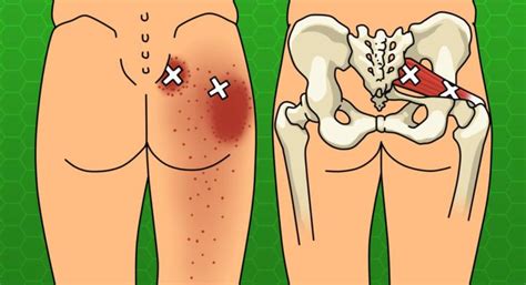 Keep Your Sciatic Back And Hip Pain Under Control With 6 ...