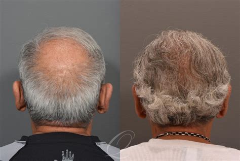 Male Crown Hair Restoration Before After Photos Patient