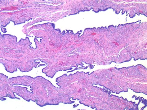 Serous Cystadenoma Histology