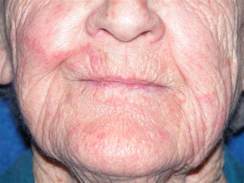 Painful Perioral Rash With Unpredictable Flare Ups The Clinical Advisor
