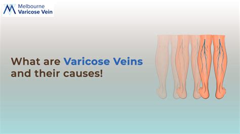 Varicose Veins Symptoms And Causes Melbourne Varicose Vein