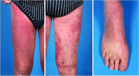 Appearance Of Cumulative Skin Toxicity Presence Of Maculopapular Rash