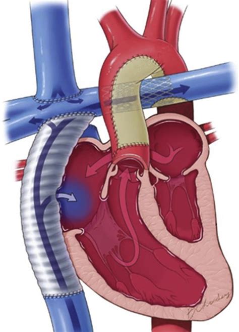 Extracardiac Fontan Operation How I Teach It The Annals Of Thoracic
