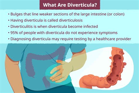 What Are Diverticula Location Effects Who Has Them