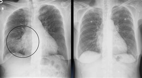 Left Lobar Pneumonia X Ray
