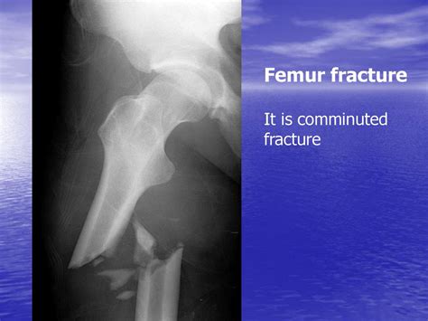 Osteoarticular Trauma Ppt Download