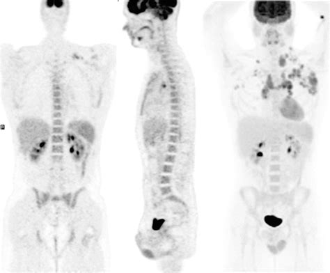 Petct In Hodgkins Lymphoma Teaching Cases Radiology Key