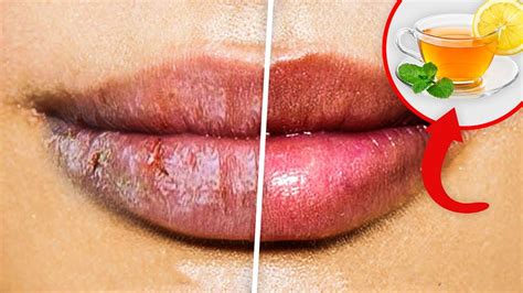 5 Home Remedies For Painful Chapped Lips How To Get Rid Of Chapped