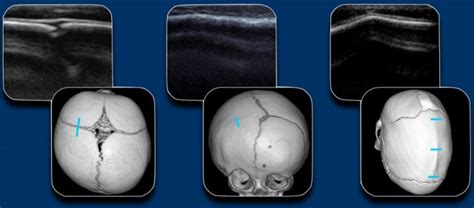 The Radiology Assistant Craniosynostosis 2022