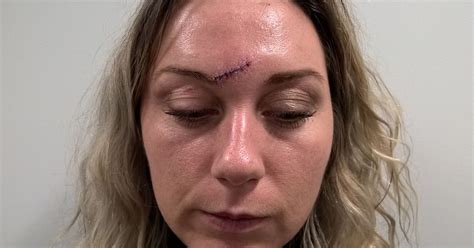 Bride To Be Left Scarred For Life After Being Attacked With Glass In City Centre Bar Mirror Online