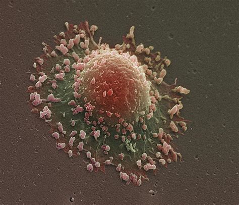 Lung Cancer Cell Sem Photograph By Steve Gschmeissner