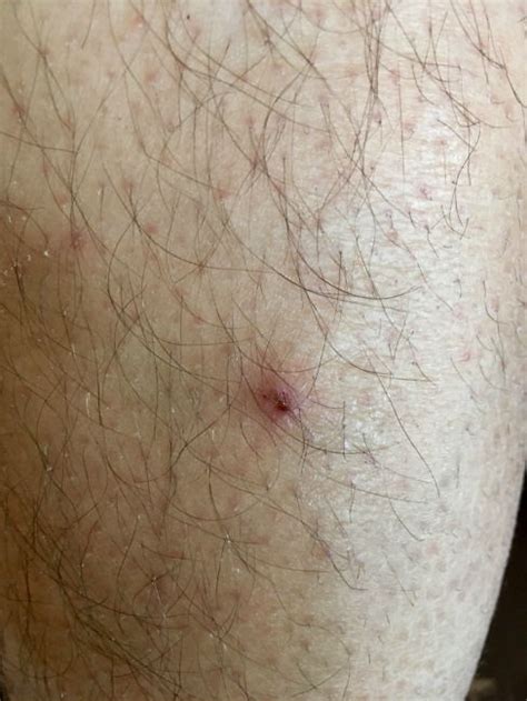 Tick Can Cause Viral Tick Disease Through Its Bite