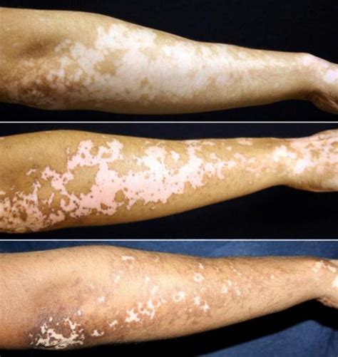 Vitiligo Treatment Holds Promise For Restoring Skin Pigmentation