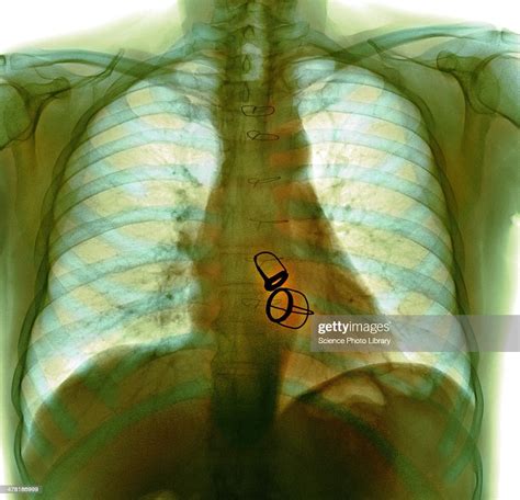 Prosthetic Heart Valves Xray High Res Stock Photo Getty Images