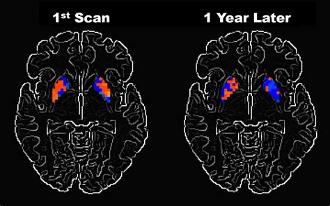 Doctors often use the hoehn and yahr scale to gauge the progression of the disease over the years. Researchers examine how Parkinson's disease alters brain activity over time | National ...