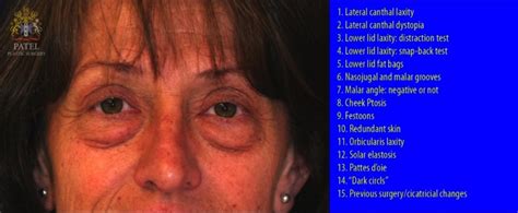 Figure Assessment Of Lower Eyelids Prior Statpearls Ncbi