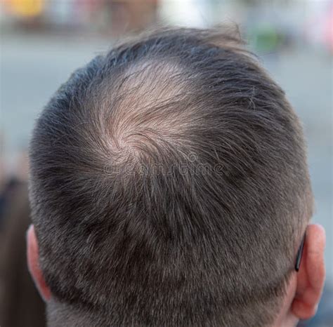 A Receding Hairline On A Man S Head Stock Image Image Of Bald Mature