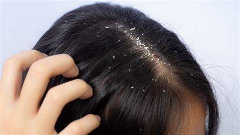 Foods That Can Cure Your Dandruff