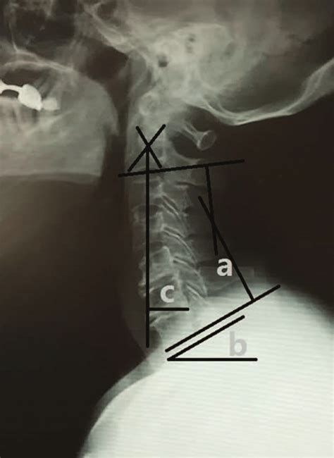 Cervical Lateral Extension And Flexion Radiographs A C2 To 7 Cobb