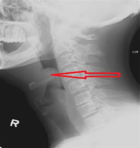 Lateral Soft Tissue Neck Radiograph Showing A Swollen Epiglottis With