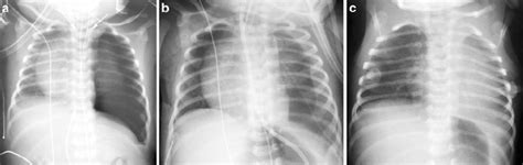 Serial Chest Radiographs In A Newborn With Left Bochdalek Hernia Show