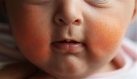 Slapped Cheek Syndrome This Childhood Condition Causes Red Cheeks