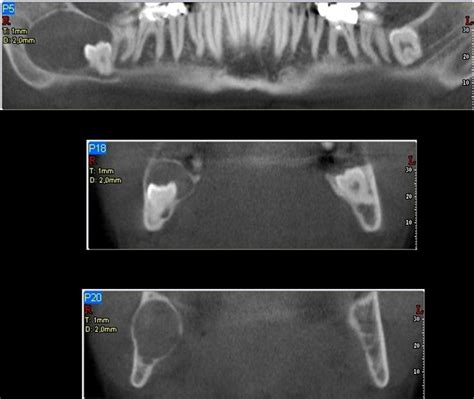 Dentigerous Cyst Cbct Sedentexcteu Cysts Dental System