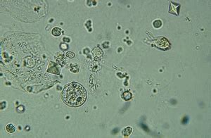 Receive all our future posts instantly in your inbox. Pus Cells In Urine 15 20 Hpf Treatment