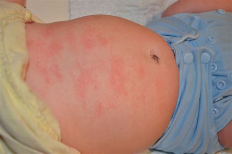 Сыпь на животе без температуры у детей причины тревожные признаки