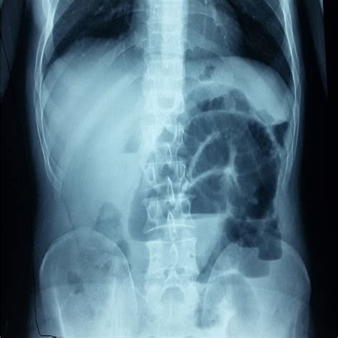 The Abdominal Radiography X Ray Demonstrated An Intestinal